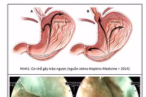Ba biến chứng của trào ngược thực quản