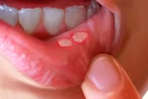  Trị chứng trong miệng lở loét