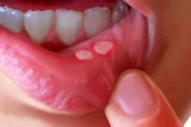  Trị chứng trong miệng lở loét