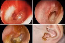 Không tự điều trị viêm tai giữa