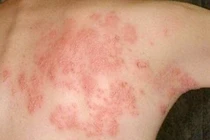 Viêm da cơ địa khó điều trị dứt điểm