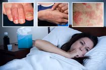 Phát ban, cước mùa đông cẩn thận nhiễm COVID-19 Omicron