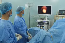 Tán vỡ sỏi to trong bàng quang tân tạo bằng laser