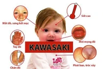 Tiến triển bệnh Kawasaki