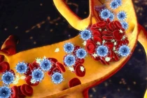 Hoại tử xương: Nguyên nhân và cách điều trị