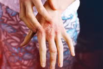 Người bệnh vảy nến cần tầm soát bệnh trước khi sử dụng thuốc sinh học