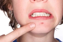 Nước bọt trị mụn