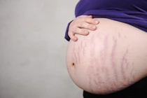 Rạn da có ảnh hưởng tới thai nhi?
