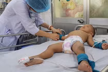 Bệnh nhân tay chân miệng tăng gấp 2,5 lần