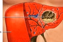  Biến chứng của bệnh áp xe gan do amip