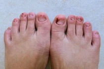 Bàn chân bất thường- triệu chứng sớm chỉ điểm cholesterol cao 