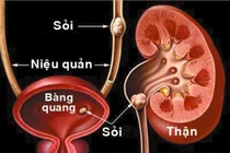 Món ăn chữa sỏi tiết niệu