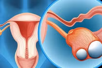 Kinh nghiệm chữa u nang buồng trứng tại nhà an toàn, hiệu quả