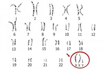 Đột biến gene hiếm gặp gây hiếm muộn 