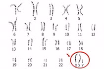 Đột biến gene hiếm gặp gây hiếm muộn 