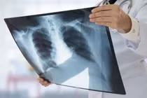  Người nghiện ma túy, rượu, thuốc lá, thuốc lào dễ mắc lao