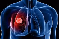 Vị trí ẩn của tế bào ung thư