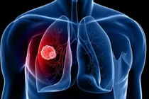 Vị trí ẩn của tế bào ung thư