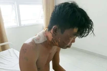 Thanh niên 24 tuổi bị chị gái đổ nồi nước sôi lên đầu