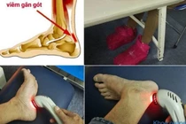 Đau sưng gót do viêm gân