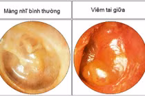 Tự chữa viêm họng dẫn đến viêm tai giữa