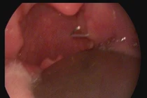 Đinh ghim trong họng bé gái 2 tuổi