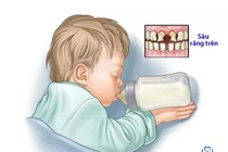 Phá hủy thân răng vì bú bình khi ngủ