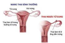  Các yếu tố nguy cơ của thai ngoài tử cung