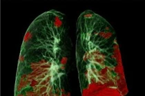 Bác sĩ lo ngại tổn thương phổi hậu Covid 