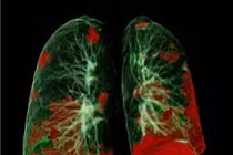 Bác sĩ lo ngại tổn thương phổi hậu Covid 