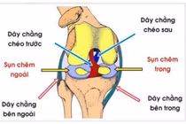 Thời điểm phẫu thuật đứt dây chằng chéo trước