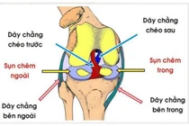 Thời điểm phẫu thuật đứt dây chằng chéo trước
