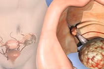 Người có nguy cơ cao mắc ung thư buồng trứng