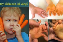 Tưởng vàng da do tăng caroten lành tính nào ngờ mắc bệnh nguy hiểm