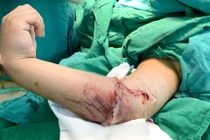 Mổ vi phẫu nối cẳng tay đứt lìa cho bệnh nhân 8 tuổi 