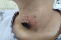 Suy giáp do đắp thuốc