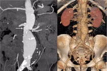 Can thiệp đặt stent Graft động mạch chủ bụng