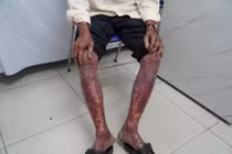 Lột da toàn thân vì nhiễm độc thuốc diệt cỏ