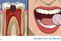 11 cách giúp bạn dịu cơn đau do mọc răng khôn