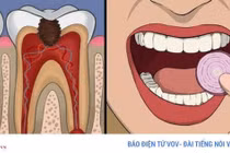 11 cách giúp bạn dịu cơn đau do mọc răng khôn