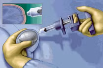 Sinh thiết tinh hoàn 