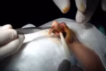 Suýt đứt lìa trụ mũi vì thẩm mỹ “dạo”