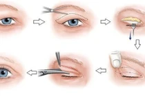 Phẫu thuật da mi thừa