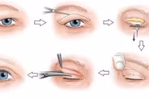Phẫu thuật da mi thừa