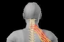  Cơn đau của hội chứng rễ tủy cổ do thoát vị đĩa đệm