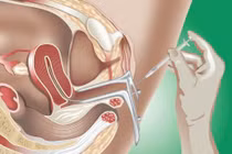 Số lượng tinh trùng đủ cho IUI