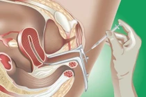 Số lượng tinh trùng đủ cho IUI