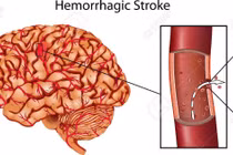 Đột quỵ chảy máu gây tổn thương nặng nề cho não bộ