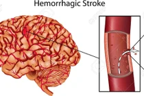 Đột quỵ chảy máu gây tổn thương nặng nề cho não bộ