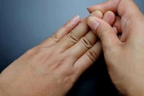 Sưng khớp nhỏ bàn tay